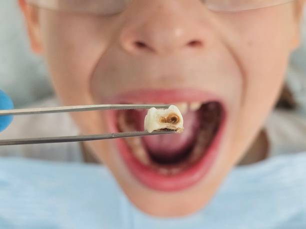 Best Emergency Treatment for Oral Infections in Riva, MD